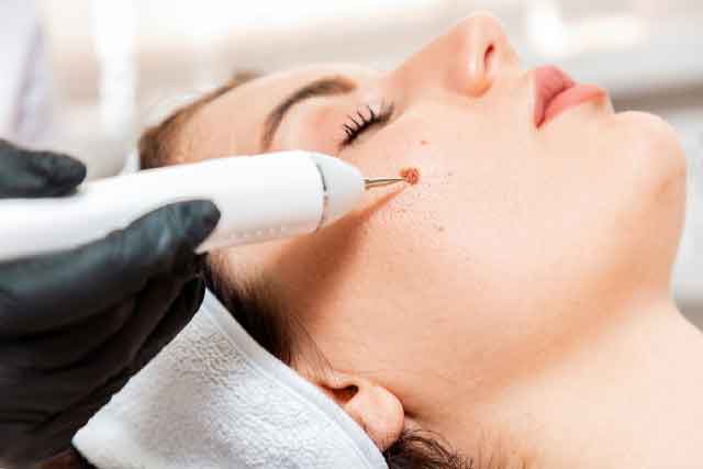 Skin tag removal treatment, Skin tag removal treatment in Pune, Skin tag removal treatment in Kharadi, Skin tag removal in pune, Skin tag removal in Kharadi, Skin tag removal